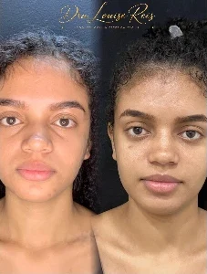 Antes e depois de tratamento no rosto